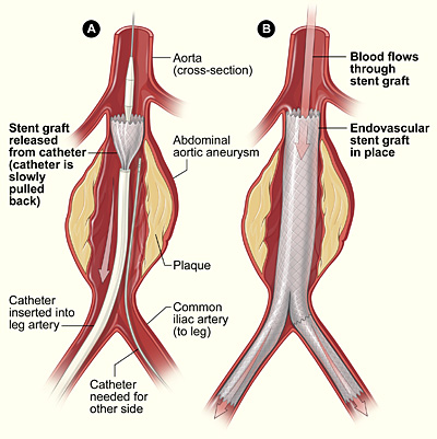 aneurysm_endovascular repair